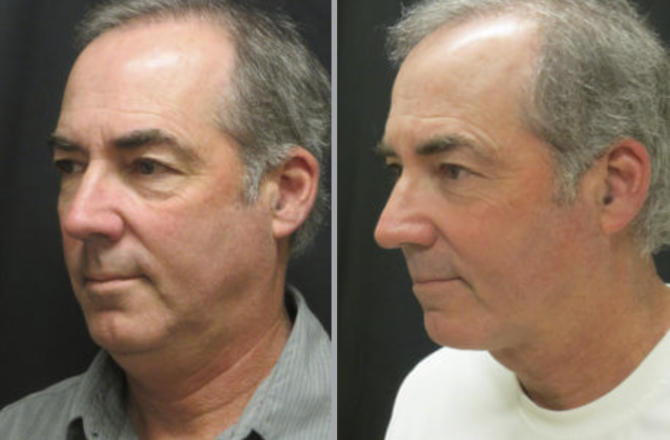 Neck Lift in Ventura, CA